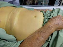 Penyakit kuning adalah kondisi menguningnya kulit dan bagian putih mata (sklera). Penyebab Jumlah Kasus Klb Hepatitis A Pacitan Kian Naik Hingga Ratusan Orang Health Liputan6 Com