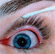 Pink Eye And The Coronavirus Visionaware