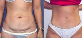 Tummy Tuck Abdominoplastia Mini Abdominoplastia Cirurgia Plastica Abdominoplastia
