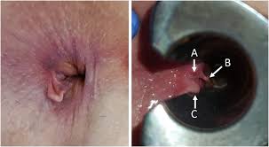 Image result for hemorrhoids