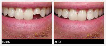 Dental insurance typically covers part of the cost of root canals. Chipped Tooth Garland Tx Broken Teeth Treatment Dental Filling