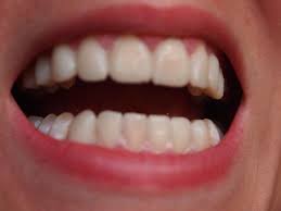 Day 1 5 Living With Temporary Veneers Veneers Porcelain Veneers Veneers Teeth