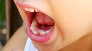 Using the extraction forceps grip the targeted tooth as low as possible, taking care not to crush or break off any pieces if possible. Child Tries To Pull Out His Second Tooth With His Fingers Video By C Rainfall Stock Footage 365845834