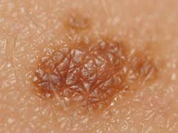 Read about the signs, symptoms, and types of breast cancer. à®‡à®ª à®ªà®Ÿ à®µà®¨ à®¤ à®…à®¤ à®µ à®® à®'à®° à®µà®• à®ª à®± à®± à®¨ à®¯ à®¤ à®© à®® à®†à®© à®‰à®¯ à®° à®• à®• à®ªà®¯à®ª à®ªà®Ÿà®¤ à®¤ à®µ à®¯ à®² à®² Skin Cancer Symptoms Types And Home Remedies Diet Tips Tamil Boldsky