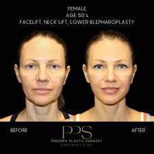 This beautiful 65-year-old underwent an abdominoplasty also known as a  tummy tuck. We are thrilled when our patients look and feel like themselves  again. Call Phoenix Plastic Surgery to set up a