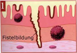 Naruse et al., fecal pancreatic elastase: Https Www Mlhb De Fileadmin User Upload Startseite Service Laborinformationen Lactoferrin Calprotectin Stuhluntersuchung 290119 Pdf