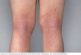 Image result for Atopic eczema atopic dermatitis