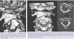 Rotatory Subluxation And Facet Deformity In The Atlanto Occipital Joint In Patients With Chronic Atlantoaxial Rotatory Fixation Two Case Reports Journal Of Orthopaedic Case Reports
