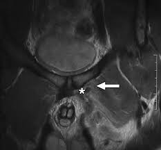 Image result for Groin Disruption