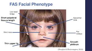 The epicanthic or epicanthal folds are either of no significance whatsoever or a potential disease marker, especially they also usually have a protruding tongue and tiny ears. Final Fasd Surp Presentation