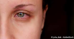 Wir sagen, in welchen fällen die maßnahmen linderung bringen und wann man der zeigefinger kreist dabei um das auge herum, immer von innen nach außen, am unteren lidrand und an der augenbraue entlang. Rote Augen Ursachen Diagnose Behandlung Netdoktor