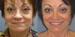 Refreshed & rejuvenated 1 week after the ReForm facelift