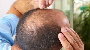 Stop hair loss before it's too late. 7 Haircuts For Balding Crown Hide Bald Spots Within Minutes