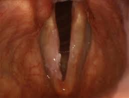 Image result for Erythroplakia roof of mouth