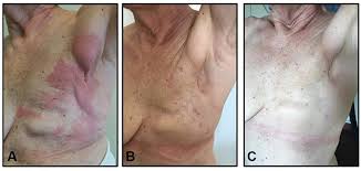 Although the percentage of cases in men is much lower than in women, male breast cancer accounts for a por. Frontiers Exceptional And Durable Responses To Tdm 1 After Trastuzumab Failure For Breast Cancer Skin Metastases Potential Implications Of An Immunological Sanctuary Oncology