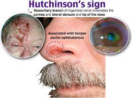 Pin On Herpes Cure