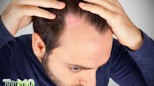 Look for labels with at least 60% ethanol or 70% isopropanol. 7 Home Remedies To Fight Ringworm Of The Scalp Top 10 Home Remedies