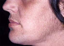 Pcos, polycystic ovary syndrome is a disorder or more likely a hormonal disorder which is common women who conceive with pcos have higher chances of premature delivery, gestational diabetes. Pco Syndrom Und Psyche Besteht Ein Zusammenhang Springerlink