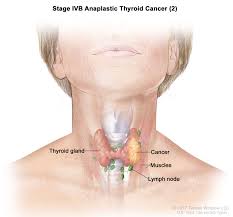 Healthy lymph nodes should feel more rubbery and pliable than the surrounding tissue but not hard as a rock. Endocrine Surgery Thyroid Cancer