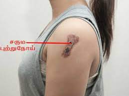 This article outlines the symptoms and signs of throat cancer, as well as its causes and process for diagnosis. à®‡à®¨ à®¤ à®†à®± à®…à®± à®• à®± à®‡à®° à®¨ à®¤ à®•à®Ÿ à®Ÿ à®¯à®® à®‰à®™ à®•à®³ à®• à®• à®ª à®± à®± à®¨ à®¯ à®‡à®° à®• à®• à®© à®…à®° à®¤ à®¤à®® à®š à®• à®ªà®£ à®£ à®• à®• à®™ à®• 6 Signs You May Have Cancer Tamil Boldsky