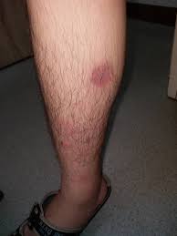 結節性紅斑(Erythema nodosum) – 肌膚親清—陳文國醫師的5分鐘皮膚專欄