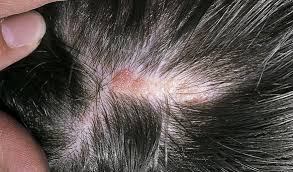 Kafa Derisinde Cikan Yara Ve Sivilcelerin Nedenleri Nelerdir