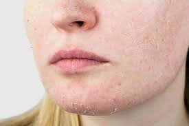 Image result for Dry Skin