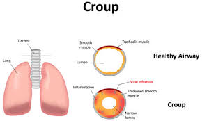 Image result for Stridor