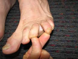 Skin problems associated with diabetes mellitus | DermNet NZ