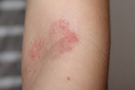 Eczema Treatment Long Island Queens New York Getting Rid Of Eczema Bergen County Nj Find & download free graphic resources for eczema. eczema treatment long island queens new york getting rid of eczema bergen county nj