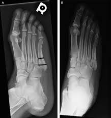 The midfoot gets no respect. Treatment Of Acute Jones Fractures Without Weightbearing Restriction Sciencedirect