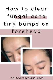 To get rid of these unwanted forehead bumps, you have to remove unwanted particles clogged in your skin. How To Clear Fungal Acne Tiny Bumps On Forehead Self Care By Sum Forehead Bumps Pimples On Forehead Forehead Acne