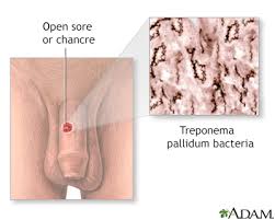 Pallidum), which is progression to secondary syphilis manifests as a generalized maculopapular rash, which. Syphilis Primary Information Mount Sinai New York