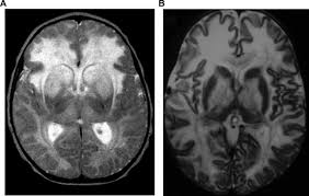 Canavan Disease