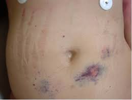 This prevents the removal of waste, and when this happens, it can give rise to. A 25 Year Old Woman With End Stage Renal Disease Low Platelet Count And Skin Rash Renal And Urology News