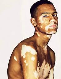 Ipl and laser assisted treatments for pigmentation are performed after rubbing numbing cream over the treatment they should not use bleaching creams or face scrubs for at least a month on the ipl or laser treated areas. Pin By Kay Lark On Persons Of Interest Vitiligo Vitiligo Model Vitiligo Treatment