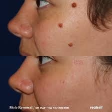 The Best Birthmark Treatments Birthmark Fair Complexion Mole Removal