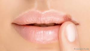 Grundsätzlich, bis die beschwerden vorbei sind und eine gesunde, zu beginn leicht rosa hautschicht die wunde bedeckt. Herpes Ansteckungsgefahr Symptome Dauer Netdoktor