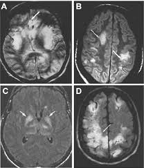 Herpes simplex encephalitis (hse) is the most common cause of fatal sporadic encephalitis worldwide. Typical Magnetic Resonance Imaging Mri Changes Associated With Viral Download Scientific Diagram