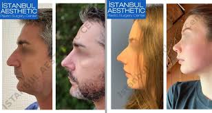 Procedures to be performed at the asc are those typically associated with cosmetic surgery, such as breast augmentation, liposuction, and face lifts. Istanbul Aesthetic Center In Turkey Prices Trusted Reviews Clinics On Call