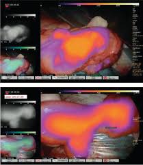 Colectomy with colocolonic, ileocolonic, or jejunocolonic anastomosis may be performed depending on the extent of the disease. Indocyanine Green Fluorescence In Colorectal Cancer Intechopen