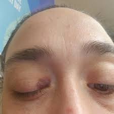 See full list on marieclaire.com I Have A Blood Vessel That Burst In My Upper Eyelid What May Have Caused This Should I Be Concerned Photo