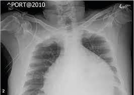 Pericarditis is an inflammation of the pericardium. Purulent Pericarditis Consultant360