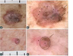 Update your find a dermatologist profile, the academy's directory that's visited by over 1 million people a year. Racgp Diagnosis And Management Of Cutaneous Melanoma
