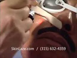 It's common on the upper lip, chin, cheeks, back, legs, fingers, feet, and toes.there are sever. Laser Hair Removal Laserspa Skin Medspa In Syracuse Ny Cny Youtube
