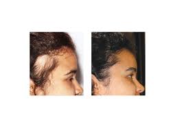 Image result for Alopecia