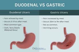 Stomach Ulcers Causes And 16 Natural Solutions Drjockers Com Stomach Ulcers Symptoms Stomach Ulcers Ulcers