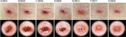 Escharotomy simply means opening the eschar. Evolution Of Eschar In Scrub Typhus In The American Journal Of Tropical Medicine And Hygiene Volume 95 Issue 6 2016