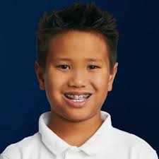 Braces in Fort Worth