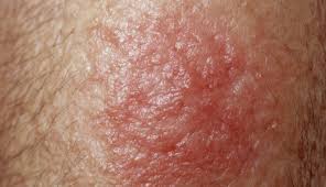 Image result for Tinea Capitis